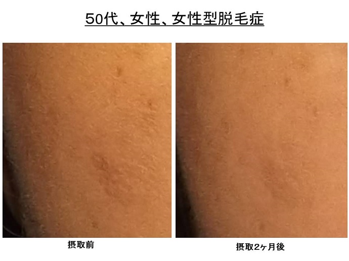 円形脱毛症　病院""